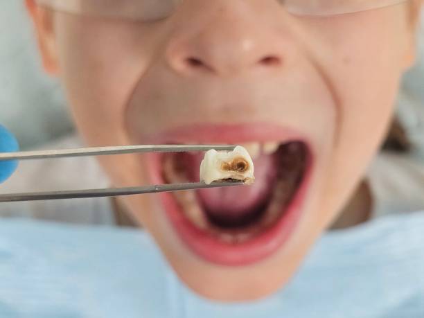 Best Emergency Root Canal Therapy in Jeffersonville, KY